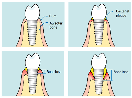 Do I have to brush my dental implants?