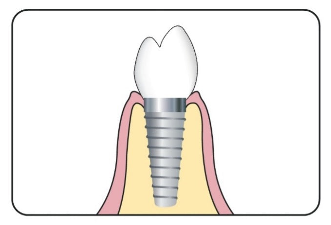 The Dental Implant Process