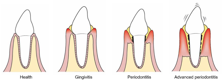 What does Bleeding Gums mean for my Oral Health?