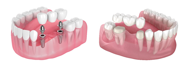 How to Clean a Dental Bridge