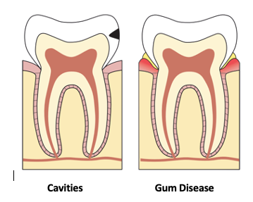 Common oral conditions for older adults