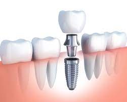 What are the advantages to implants?