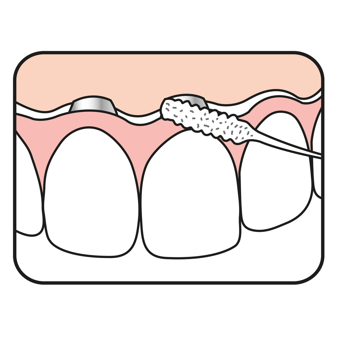 TePe Bridge and Implant Floss